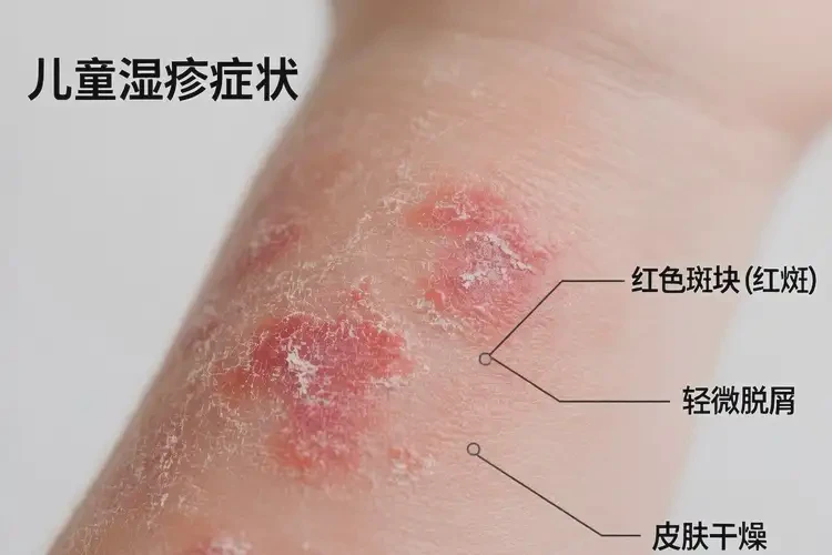 兒童手臂經(jīng)常長(zhǎng)濕疹不管它會(huì)自己好嗎(圖3)