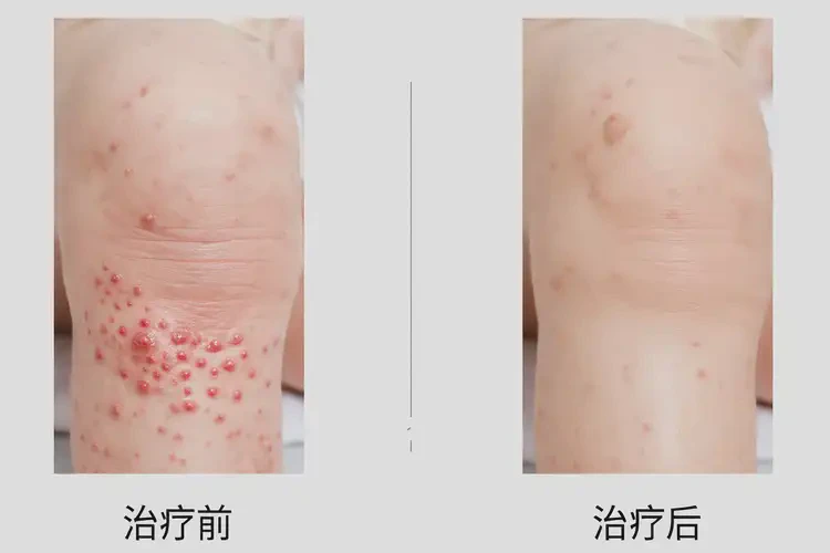 嬰幼兒大腿上經常起濕疹不管它會自己自愈嗎(圖2)