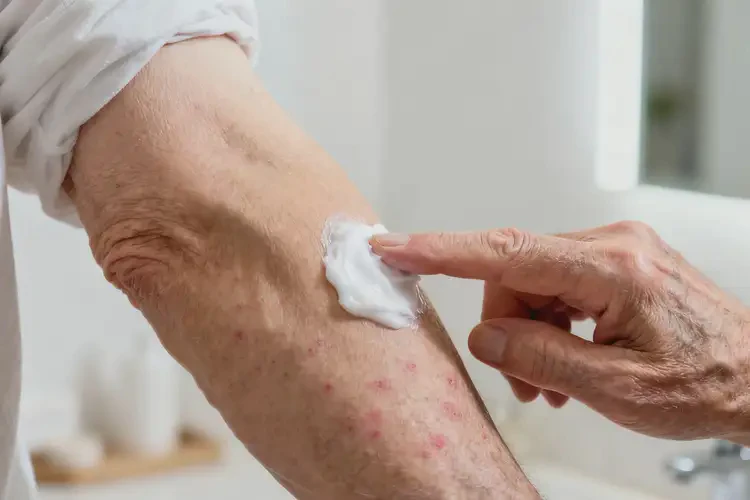 老年人手臂經(jīng)常起濕疹可以徹底自愈嗎(圖4)