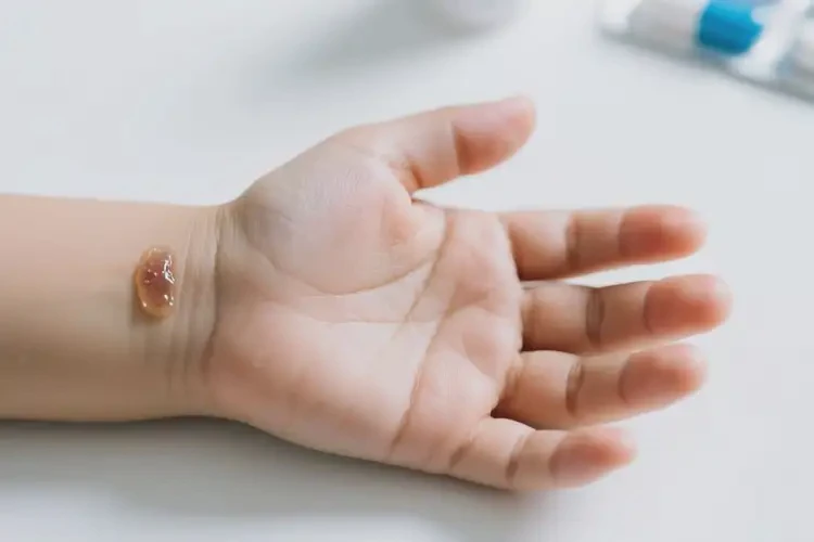 兒童手上起濕疹不管它會(huì)自己痊愈嗎(圖3)