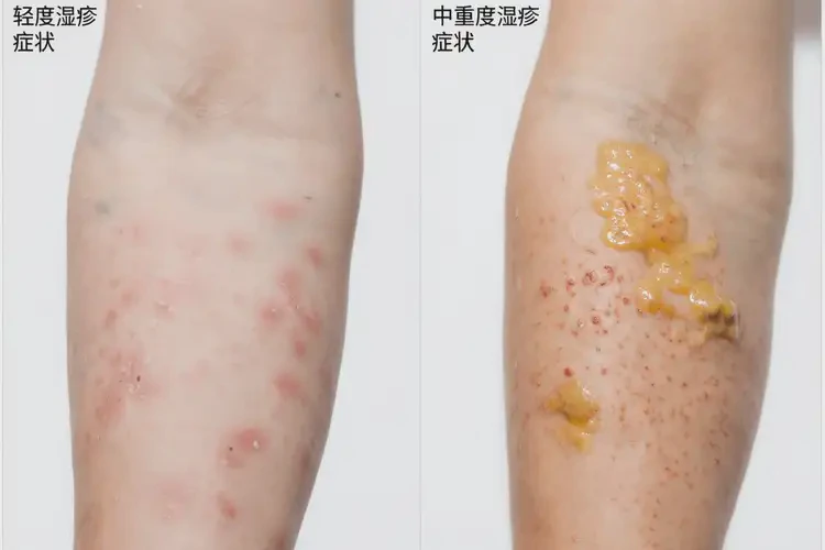 男生手臂上容易長濕疹能靠自己自愈嗎(圖1)