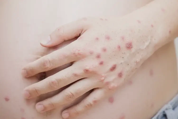 產(chǎn)婦手上偶爾起濕疹不管它會自己好嗎(圖3)