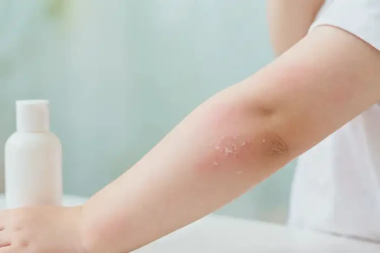 幼兒手臂偶爾起濕疹可以徹底自愈嗎(圖2)