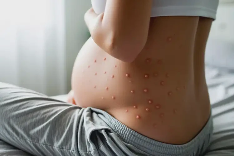 孕妇屁股长湿疹能靠自己自愈吗(图1)