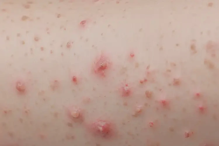 小孩全身起湿疹可以彻底自愈吗(图4)