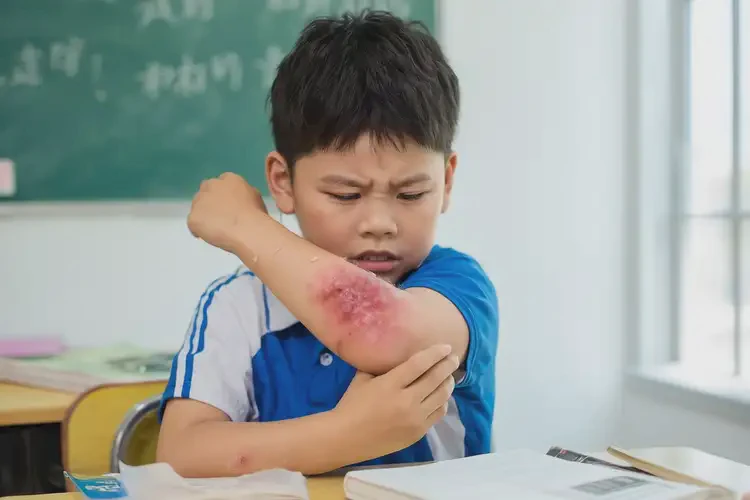 小學(xué)生手臂容易長濕疹不管它會自己痊愈嗎(圖4)