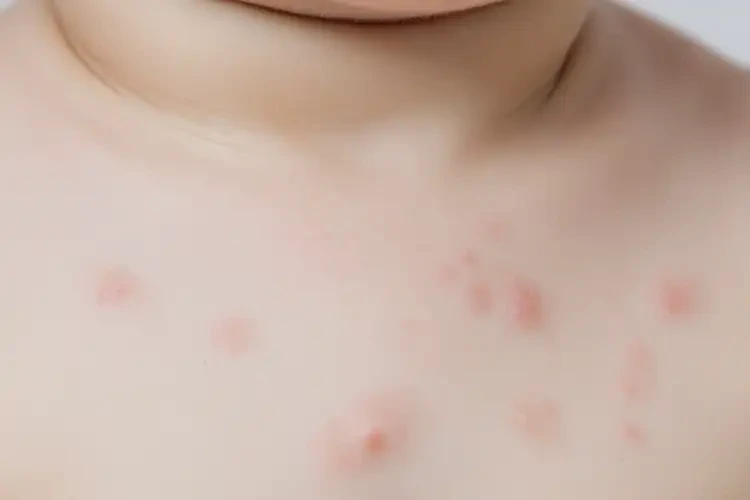 婴幼儿脖子长湿疹可不可以彻底自愈(图4)
