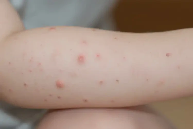 小孩手臂長濕疹能靠自己自愈嗎(圖4)