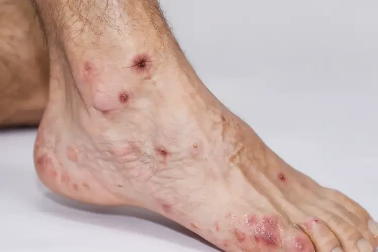 青年人腳上容易長(zhǎng)濕疹不管它會(huì)自己好嗎(圖4)