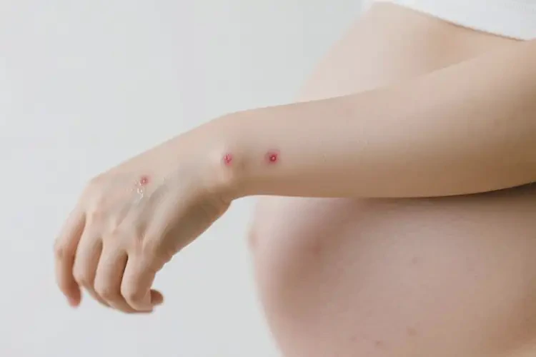 孕婦手臂偶爾起濕疹不管它會自己痊愈嗎(圖2)