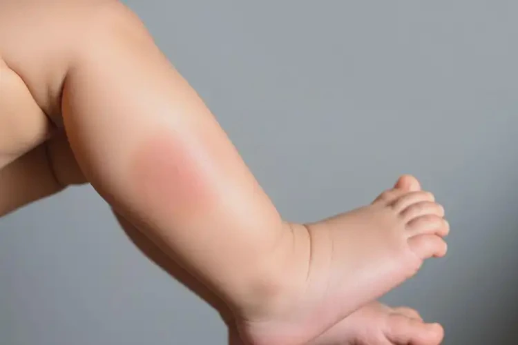 嬰幼兒小腿偶爾長濕疹不管它會自己自愈嗎(圖1)