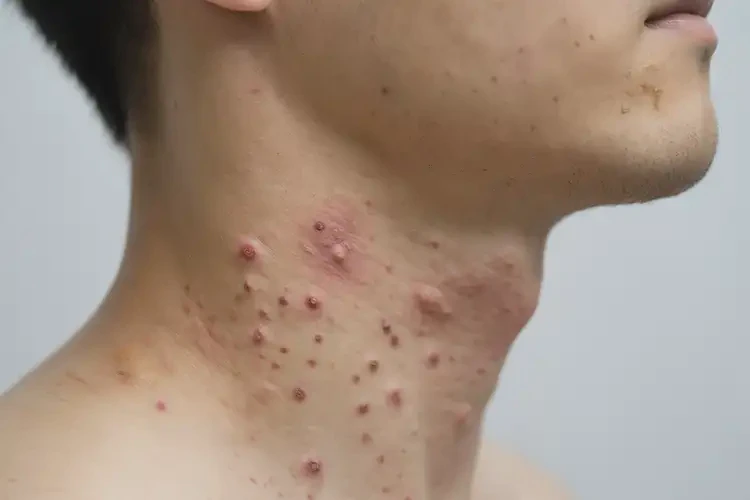 青年人脖子上有濕疹能不能徹底自愈(圖3)