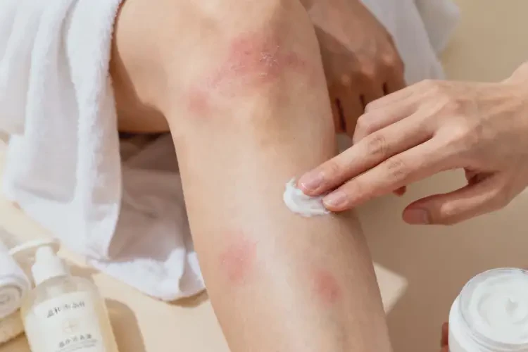 青年人大腿上出現(xiàn)濕疹能夠徹底治愈嗎(圖4)