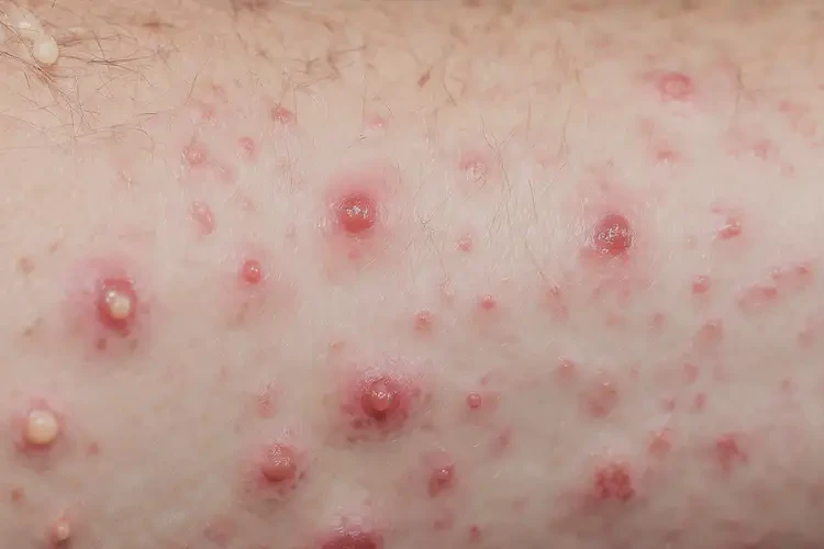 男人屁股出濕疹不管它會(huì)自己自愈嗎(圖4)