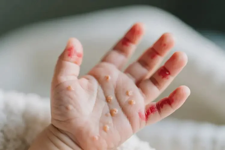 嬰兒手上起濕疹不管它會自己痊愈嗎(圖1)