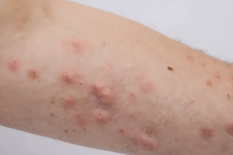 大學(xué)生小腿有濕疹不管它會自己自愈嗎(圖3)