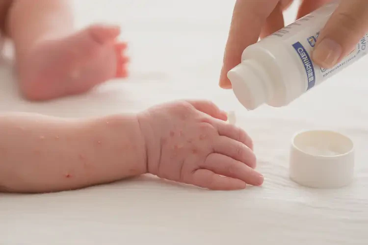 新生兒手上出現(xiàn)濕疹不管它會(huì)自己痊愈嗎(圖3)