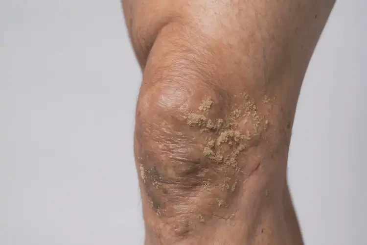 男生大腿出現(xiàn)濕疹能徹底自愈嗎(圖1)