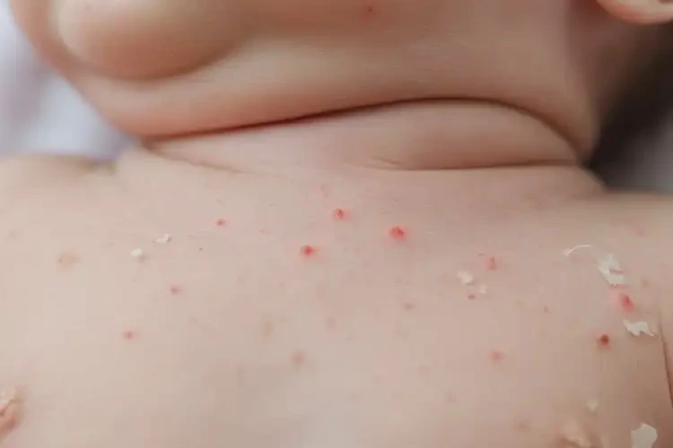 新生兒脖子長(zhǎng)濕疹可不可以徹底自愈(圖4)