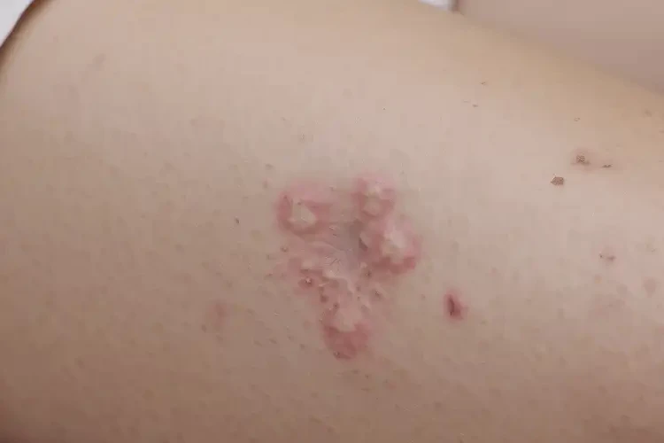 產(chǎn)婦大腿容易起濕疹可以徹底自愈嗎(圖4)