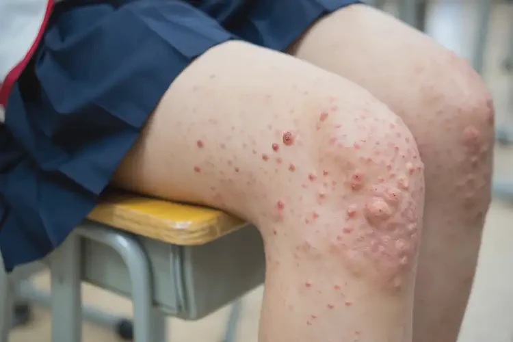 中学生大腿起湿疹能够彻底治愈吗(图4)