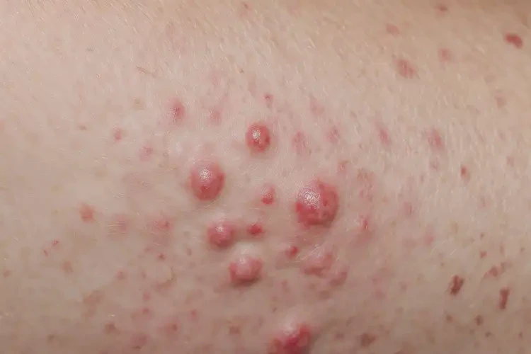 产妇肛周容易起湿疹可不可以彻底自愈(图4)