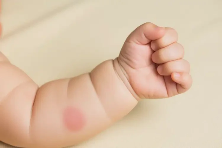 嬰兒手臂上偶爾長濕疹能夠徹底治愈嗎(圖4)