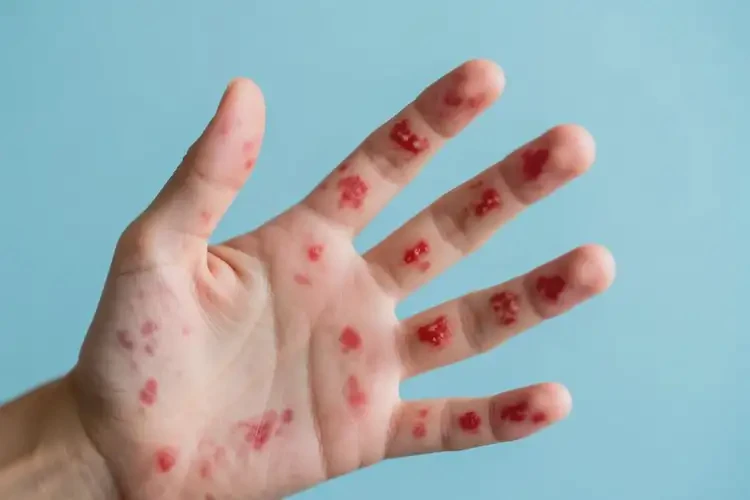 中學生手上容易長濕疹不管它會自己自愈嗎(圖4)