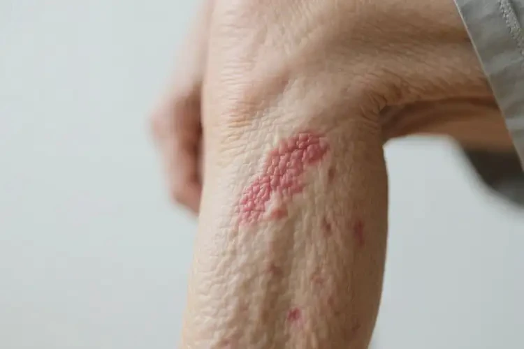 高齡老人大腿上出濕疹不管它會(huì)自己自愈嗎(圖1)