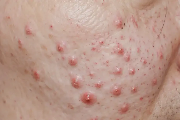 女生面部经常起湿疹不管它会自己痊愈吗(图4)