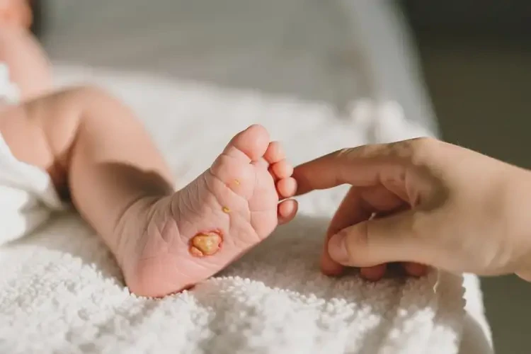 新生兒腳上出現(xiàn)濕疹可以徹底自愈嗎(圖3)