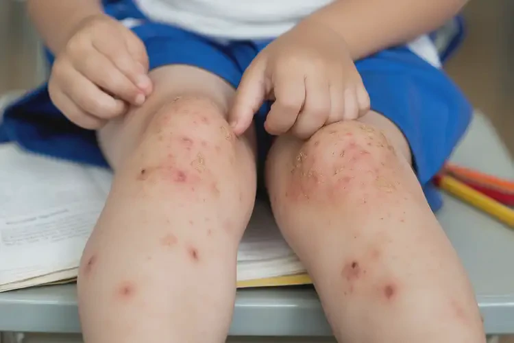 小學(xué)生大腿偶爾長濕疹不管它會自己痊愈嗎(圖4)