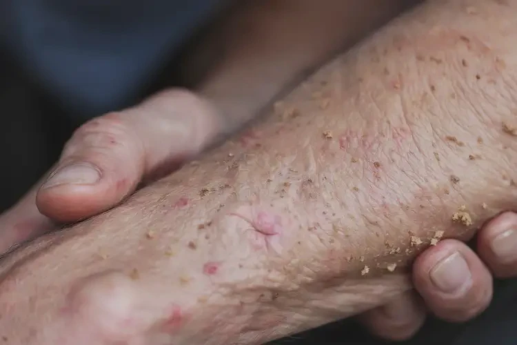 高齡老人全身容易起濕疹能徹底自愈嗎(圖4)