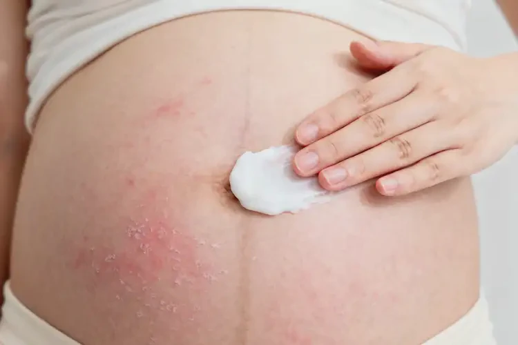 產(chǎn)婦肚子經(jīng)常起濕疹不管它會自己好嗎(圖1)