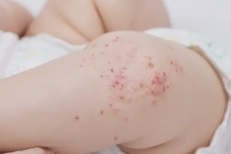 嬰幼兒大腿上經常起濕疹不管它會自己自愈嗎(圖4)