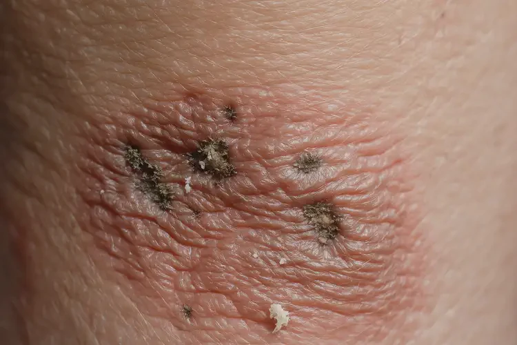 产妇小腿上出湿疹可不可以彻底自愈(图2)