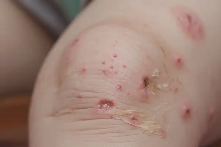小孩小腿容易長濕疹可以徹底自愈嗎(圖4)