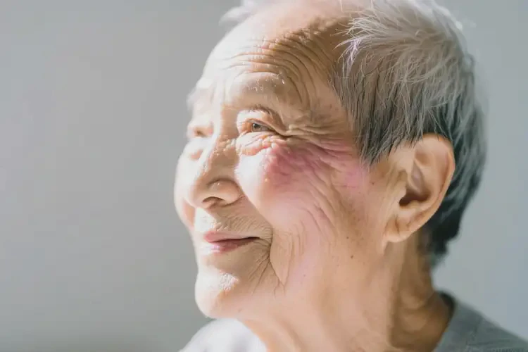 高齡老人面部容易長(zhǎng)濕疹能不能徹底自愈(圖3)