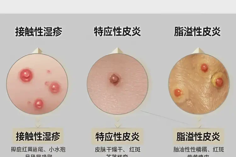 女生手臂上偶尔长湿疹不管它会自己好吗(图4)