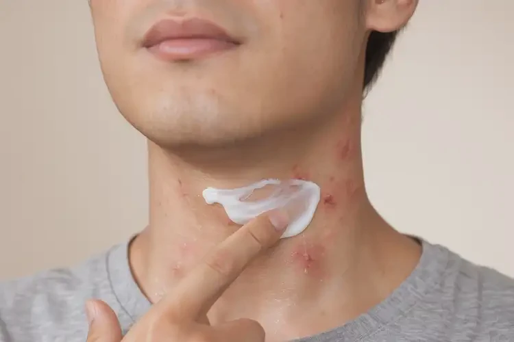 青年人脖子容易長濕疹可以徹底自愈嗎(圖3)