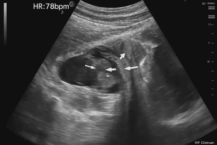 孕18周3天胎心率79怎么回事(圖4)