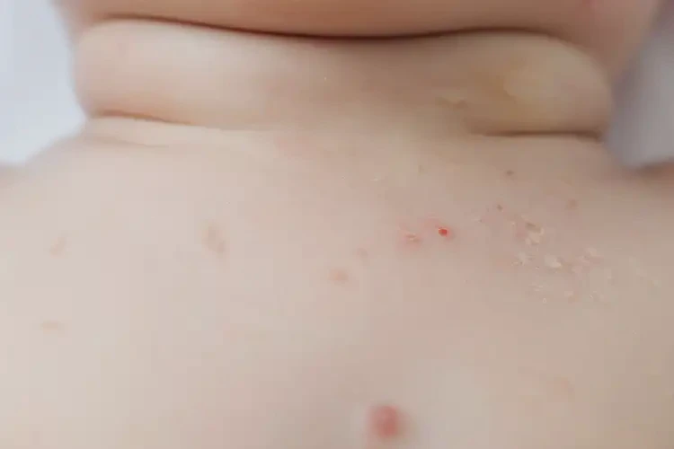 儿童脖子偶尔长湿疹不管它会自己痊愈吗(图4)