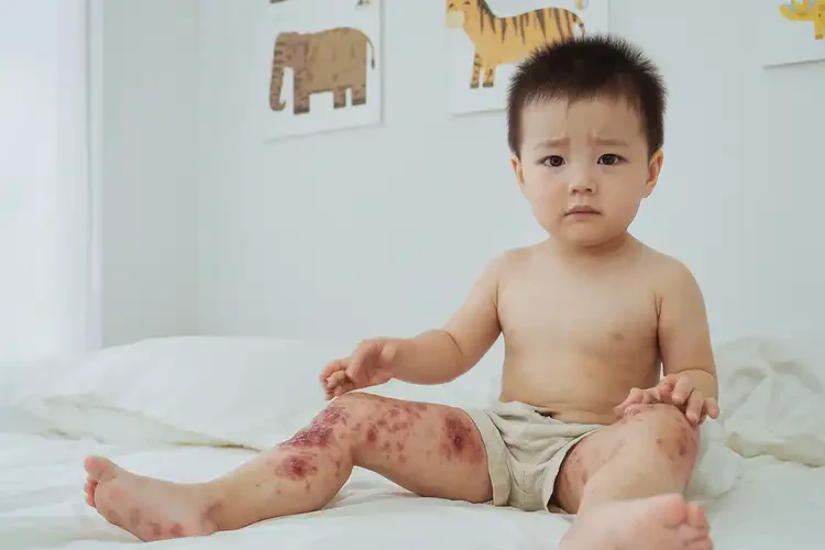 幼兒大腿偶爾起濕疹可以徹底自愈嗎(圖4)