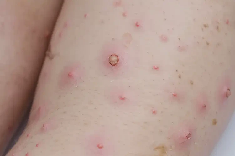 少兒四肢起濕疹能靠自己自愈嗎(圖4)