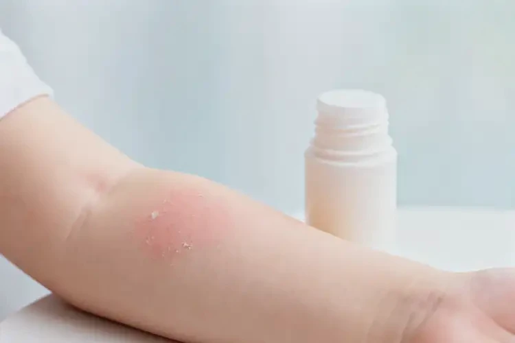幼兒手臂偶爾起濕疹可以徹底自愈嗎(圖4)