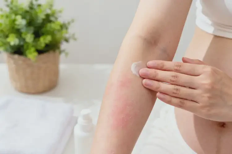 哺乳期媽媽手臂有濕疹能不能徹底自愈(圖3)