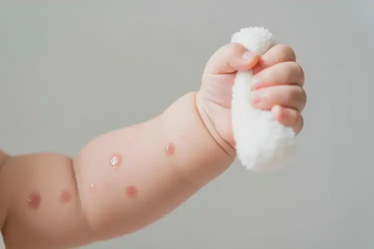 嬰兒手臂上偶爾長濕疹能夠徹底治愈嗎(圖3)