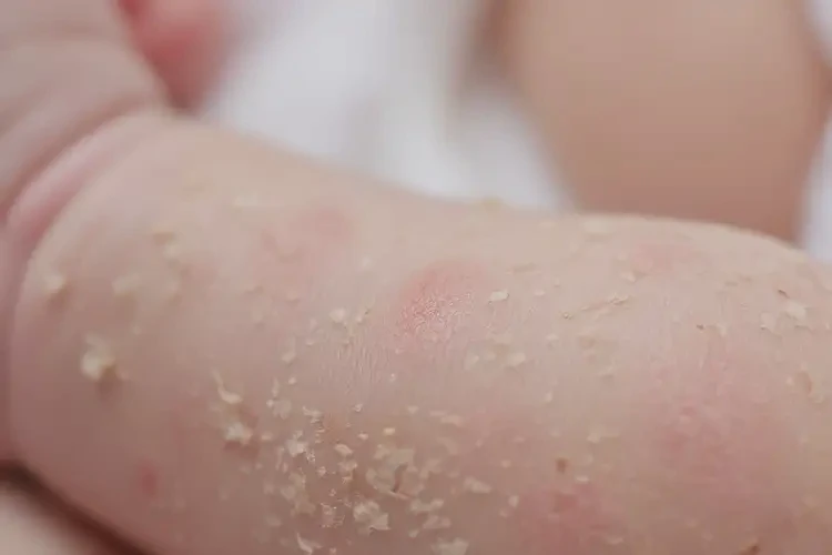 新生兒手臂上經(jīng)常長濕疹可以徹底自愈嗎(圖4)