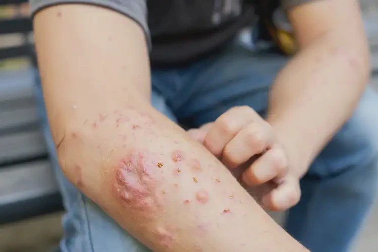 大學生手臂上出濕疹能不能徹底自愈(圖4)