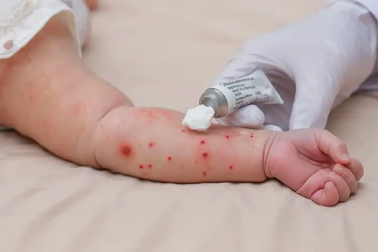 新生兒手臂有濕疹不管它會自己好嗎(圖2)